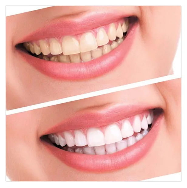 Teeth Whitening kit